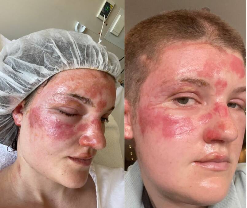 Olivia suffered second degree burns to her face following the fire and later shaved her head due to damage to her hair. 